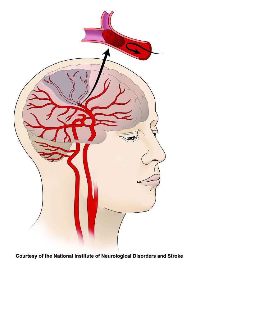 IschemicStrokeImage2